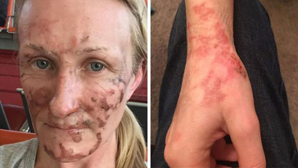 Guest Sues Disneyland Paris After Being Burned by Chef